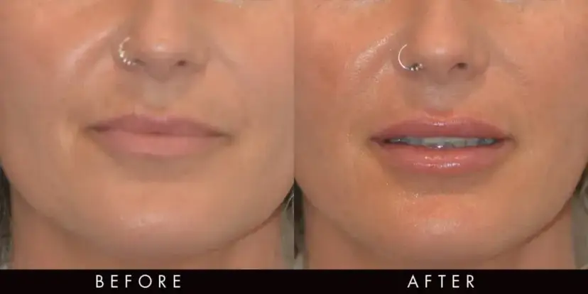 0,5 ml kwasu hialuronowego: Ile kosztuje i jakich efektów się spodziewać?