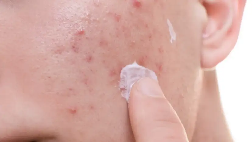 Palec nakłada krem na skórę z widocznymi stany zapalne na twarzy.