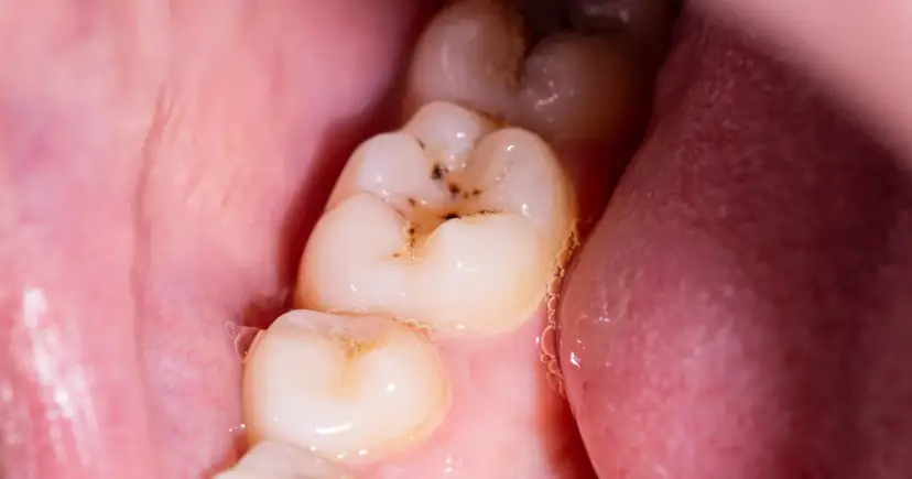 Jak wyleczyć próchnicę w domu? Kiedy to możliwe, a kiedy musisz iść do dentysty?