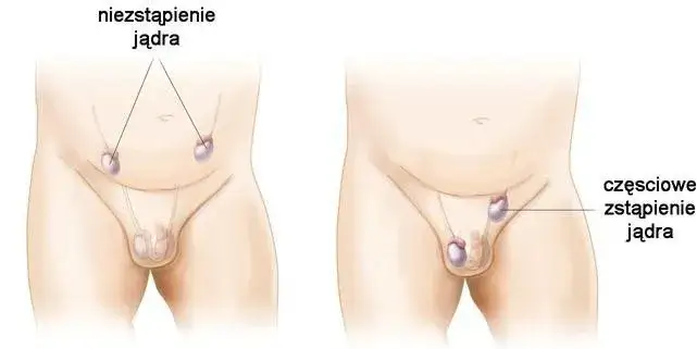 Jedno jądro większe? Kiedy to norma, a kiedy problem?