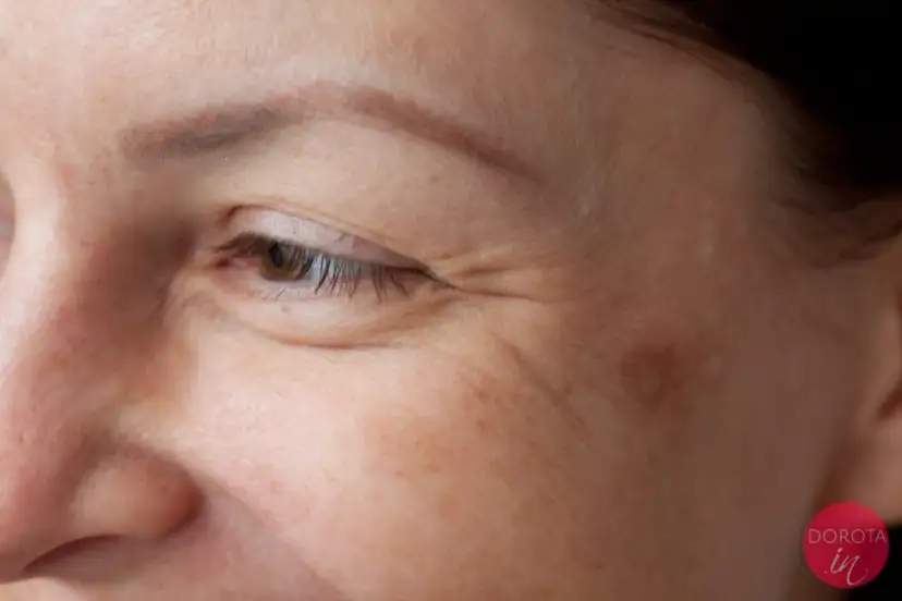 Kwas hialuronowy: Dlaczego efekty znikają i jak je przedłużyć?