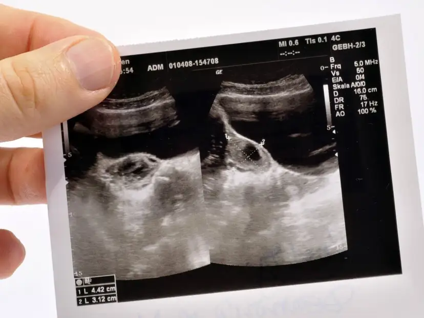 Zyste am Eierstock: Müdigkeit als Symptom? Ursachen & Hilfe