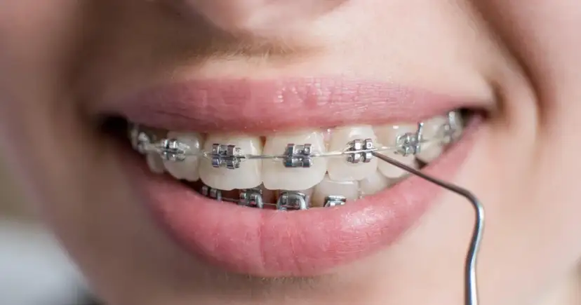 Aparat na wszystkie zęby? Kiedy to konieczność, a kiedy wyjątek?