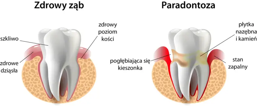 Zdrowe dziąsła: Jak dbać, by uniknąć paradontozy i krwawienia?