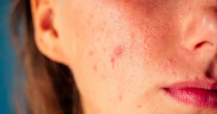 Skąd się biorą pryszcze? Oto przyczyny, które musisz znać