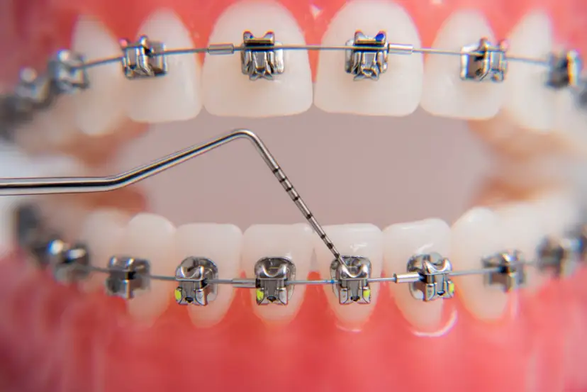 Ból po aparacie ortodontycznym: Jak sobie radzić i czy warto?