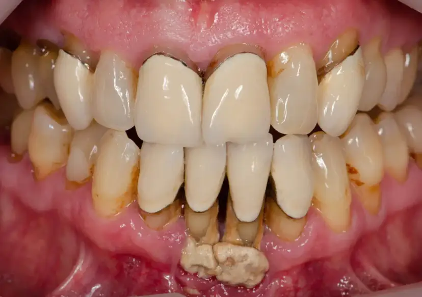 Zaawansowana paradontoza kiedy wypadają zęby. Widoczne są odsłonięte korzenie, kamień nazębny i stan zapalny dziąseł.