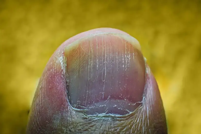 Jak skutecznie pozbyć się pionowych bruzd na paznokciach i poprawić ich wygląd