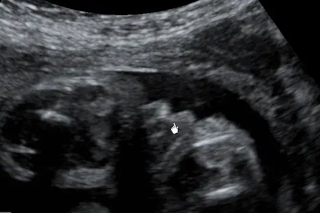 Kiedy poznać płeć dziecka? USG, NIPT i wiarygodne terminy