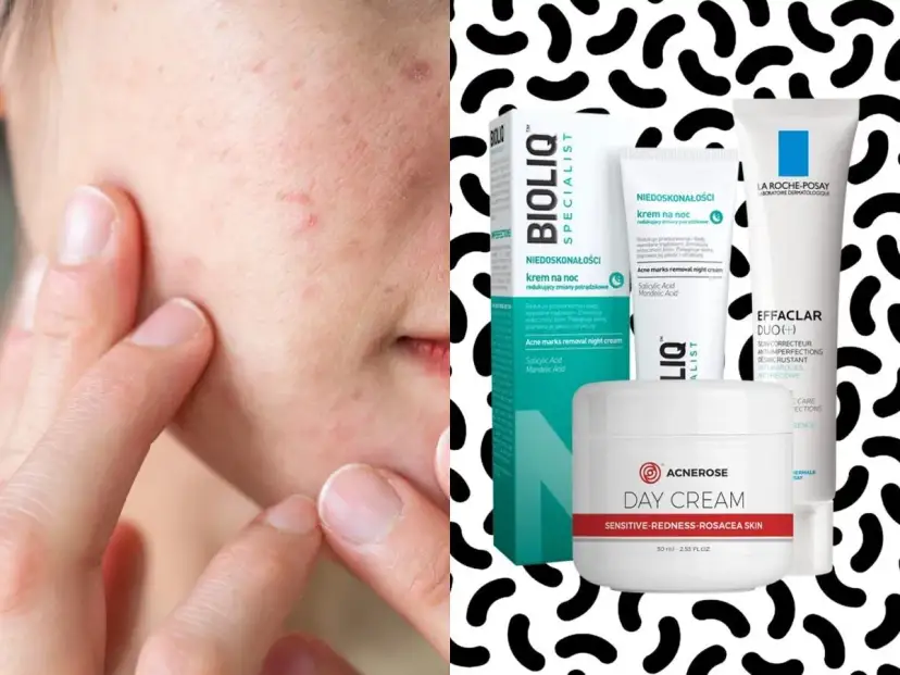Skuteczne kremy na niedoskonałości: Jak pozbyć się trądziku i wyprysków