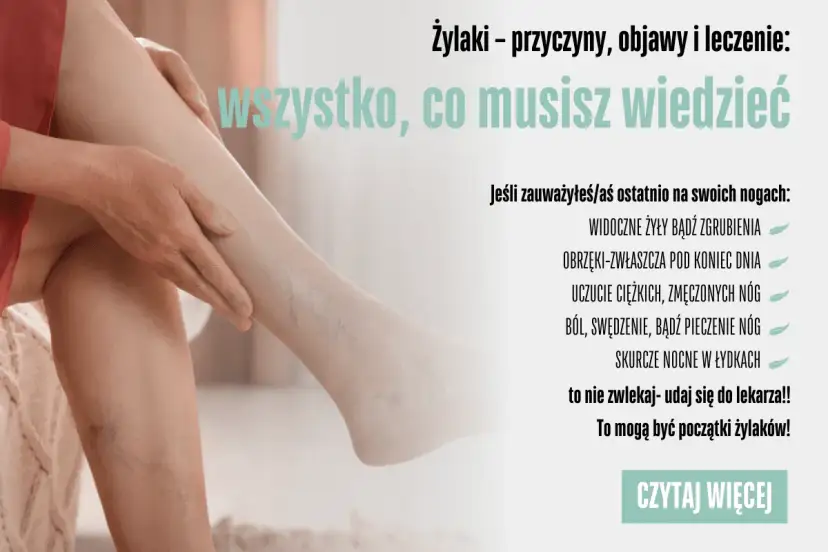 Żylaki? Jak zapobiec i cieszyć się lekkimi nogami każdego dnia