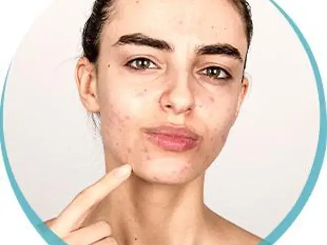 Pryszcze objawy ciąży: Jak hormonalne zmiany wpływają na skórę