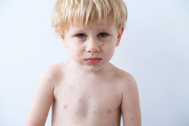 Jakie leki na bostonkę pomogą złagodzić objawy u dzieci?