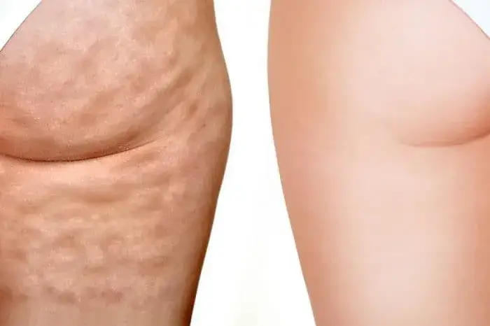 Jak usunąć cellulit? Domowe sposoby i zabiegi, które działają!