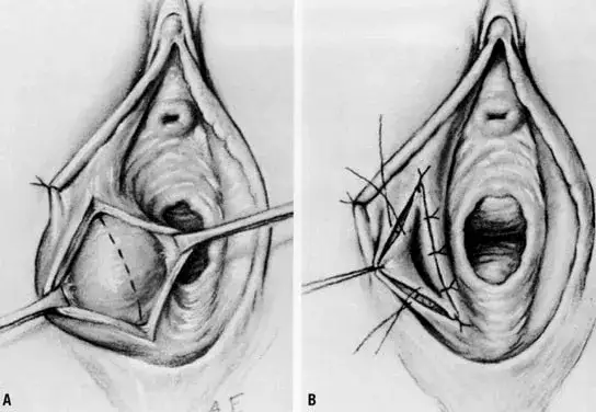 Zapalenie gruczołu Bartholina objawy: jak je rozpoznać i leczyć
