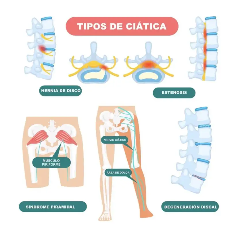 ¿Es ciática? Reconoce síntomas, causas y cuándo actuar