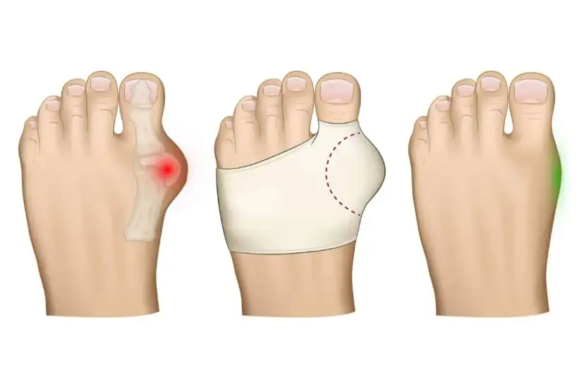 Haluksy po operacji: Czy nawrót jest możliwy? Co musisz wiedzieć