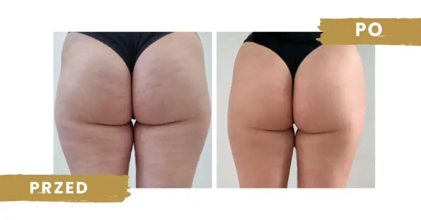 Endermologia: Jak działa, efekty, cena i wskazania poznaj wszystko