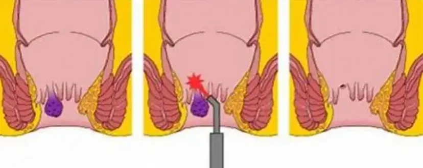 Jak skutecznie leczyć szczelinę odbytu? Od leków po Botoks