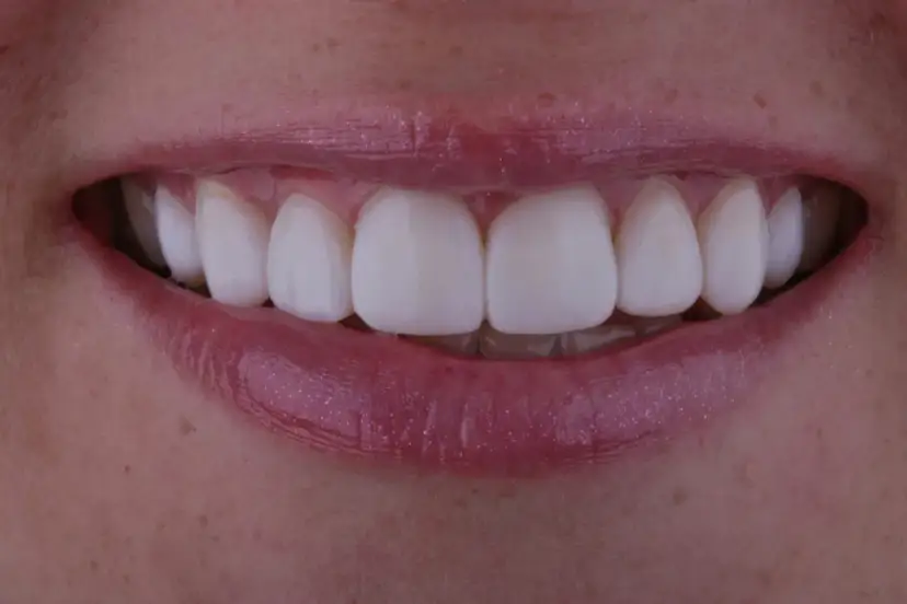 Ile kosztuje bonding zębów? Ceny, ukryte koszty i opłacalność.