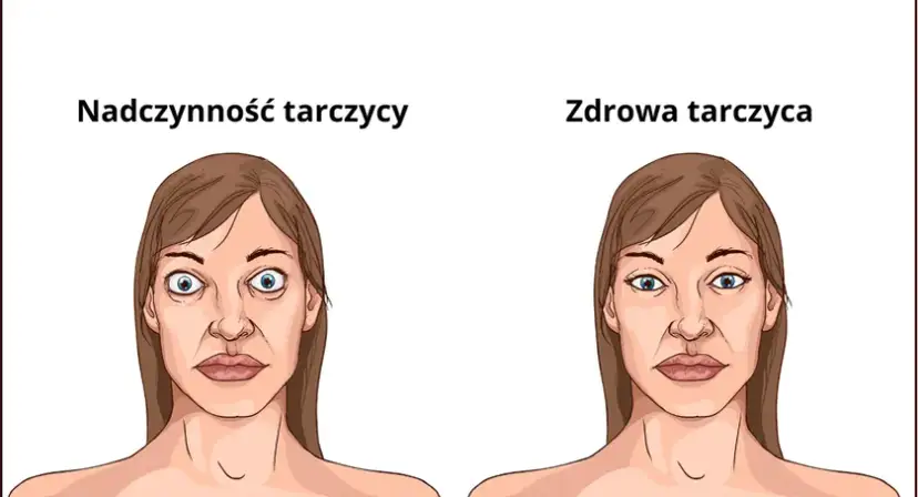 Nadczynność tarczycy objawy psychiczne - jak je rozpoznać i leczyć