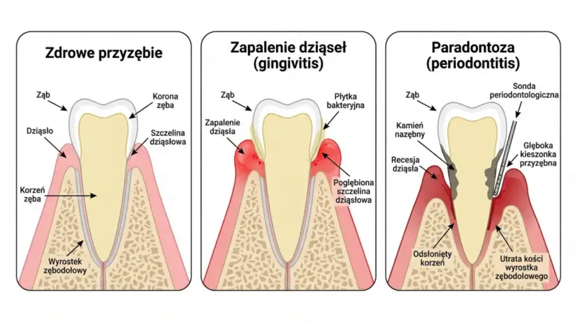Ilustracja pokazuje postęp chorób przyzębia: zdrowe dziąsła, zapalenie dziąseł i paradontozę. Czy paradontoza jest zaraźliwa?