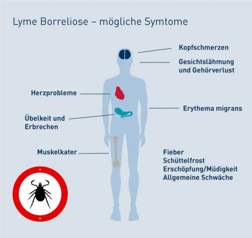Borreliose Symptome: So erkennen Sie die Anzeichen einer Zeckeninfektion