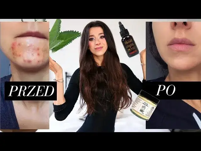 Jak zakryć pryszcza domowym sposobem i uniknąć nieprzyjemnych skutków