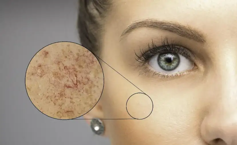 Cera naczynkowa: Czego unikać? Poznaj czarną listę dla ukojenia