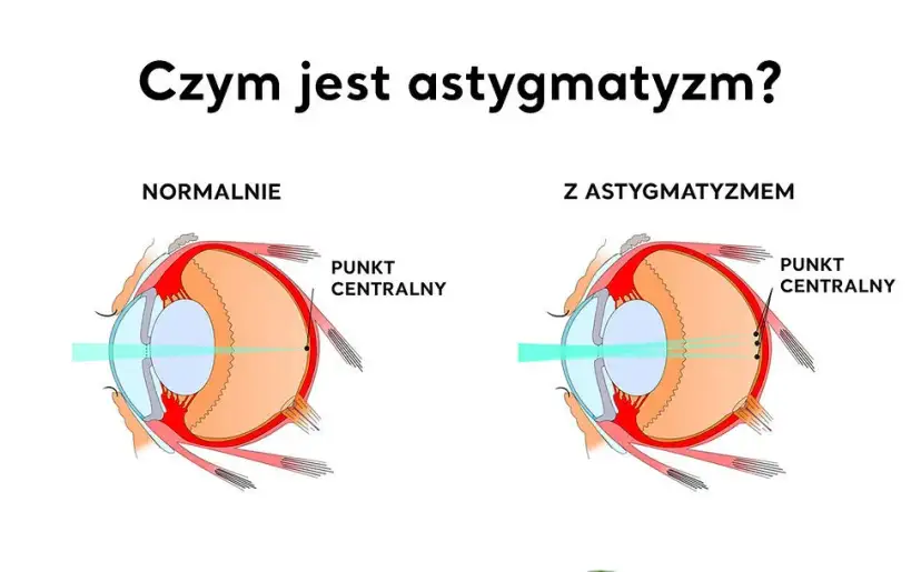 Astygmatyzm: Kiedy do okulisty, a kiedy do optometrysty?