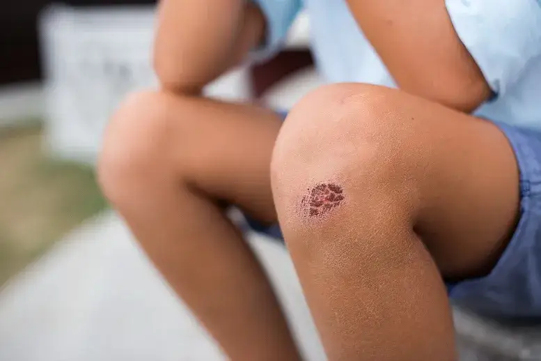 Ile goi się strup po pryszczu? Oto, co musisz wiedzieć, aby uniknąć blizn