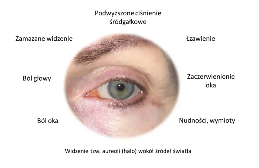 Jaskra objawy początkowe: Jak rozpoznać cichego złodzieja wzroku?