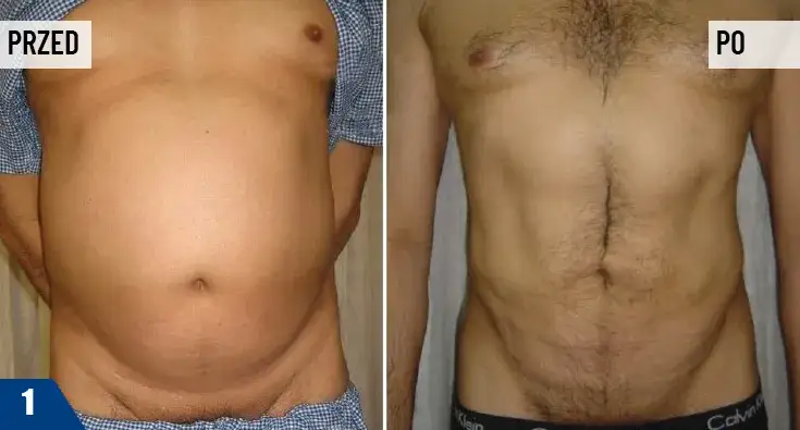 Liposukcja: Czy boli? Bezbolesny zabieg, kontrolowany dyskomfort