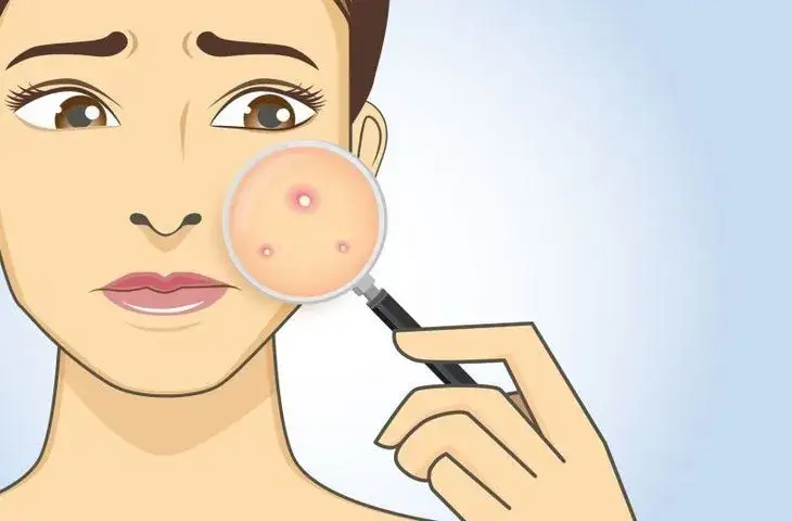 Maść Ichtilowa na Pryszcze: Jak Stosować? Instrukcja Krok po Kroku