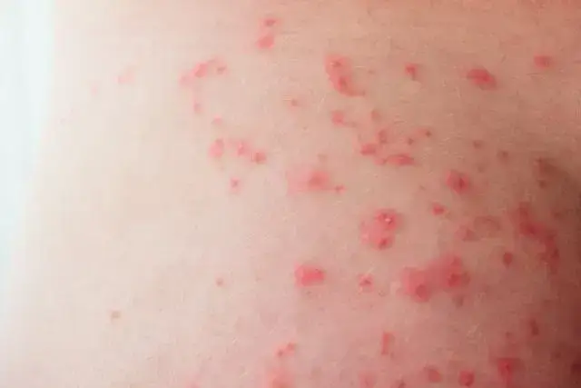 Krostki na pośladkach: Przyczyny i skuteczne sposoby na gładką skórę