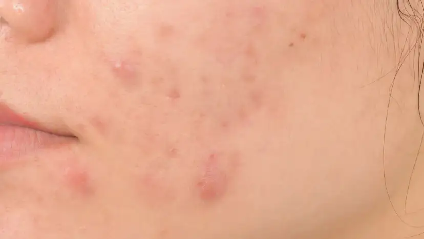 Pryszcze na pośladkach: Skuteczne metody i przyczyny. Poznaj plan!