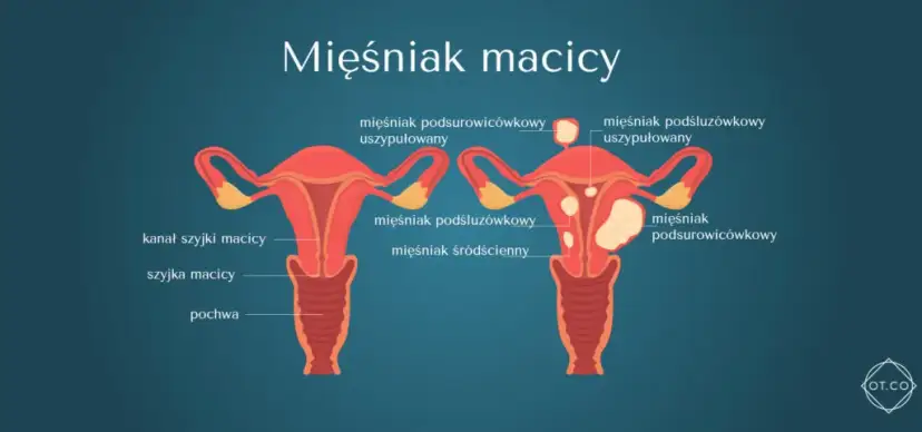 Rosnący mięśniak po menopauzie: Kiedy to sygnał alarmowy?