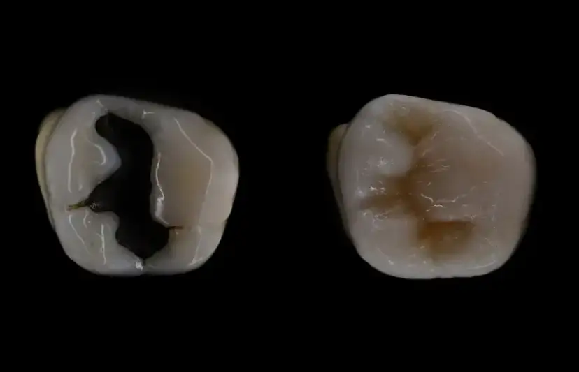 Ile kosztuje plomba na NFZ? Sprawdź ukryte koszty i różnice