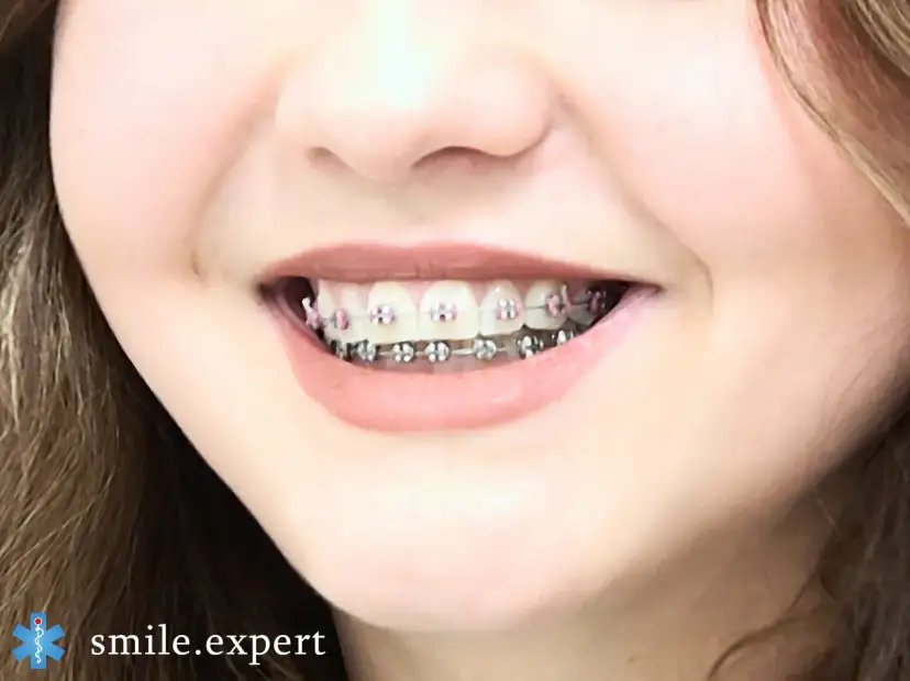 Ile trwa leczenie ortodontyczne? Poznaj realny czas i czynniki