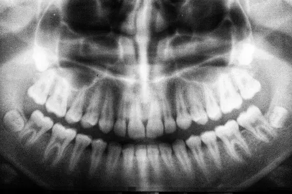 Ile jest zębów u dorosłych? Odkryj, co wpływa na ich liczbę
