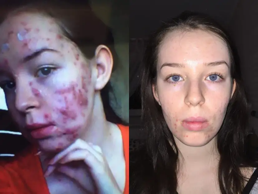 Izotek skutki uboczne: Jak bezpiecznie przejść terapię?