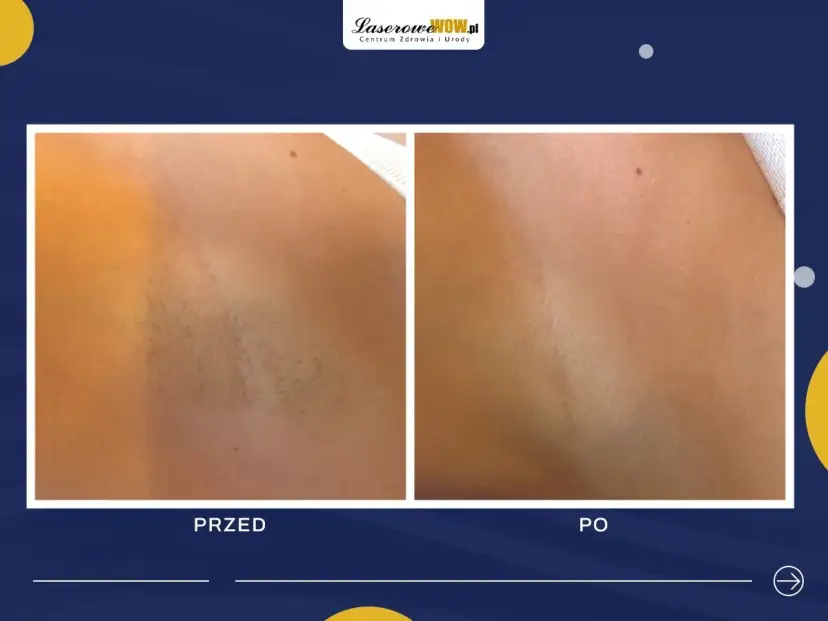 Depilacja laserowa: jak często? Ekspert radzi dla trwałych efektów