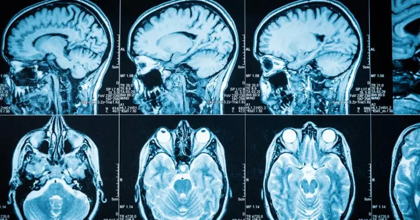 Guz mózgu objawy psychiczne: jak rozpoznać niebezpieczne sygnały