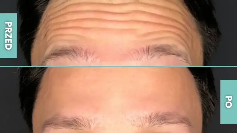 Botoks czy kwas na czoło: co wybrać dla wygładzenia zmarszczek?