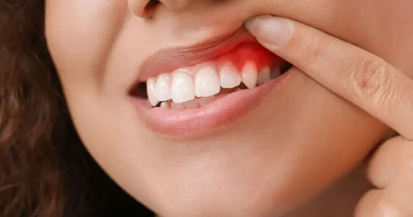 Krwawienie dziąseł: sygnał, którego nie możesz ignorować. Co robić?