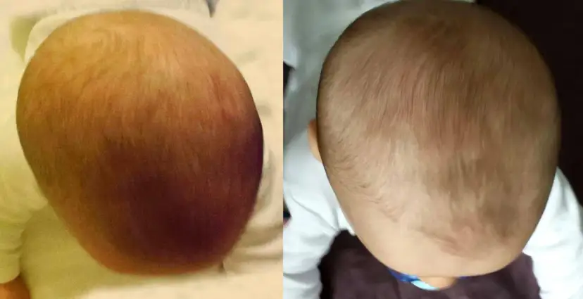 Head Care: Po jakim czasie poduszka skoryguje spłaszczoną główkę?