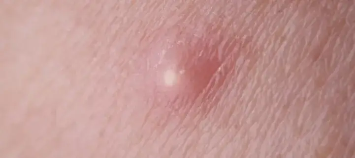 Czyrak czy pryszcz: jak je odróżnić i skutecznie leczyć?