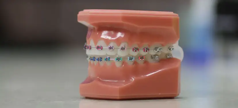 Jak przyciąć drut od aparatu ortodontycznego bez ryzyka uszkodzenia