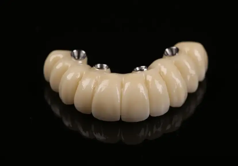 Ile kosztuje implant zęba? Sprawdź ceny i ukryte wydatki