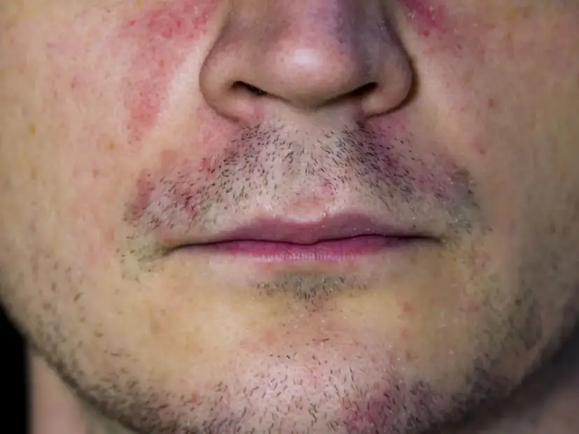 Czerwone ślady po pryszczach? Poznaj metody na rumień PIE!